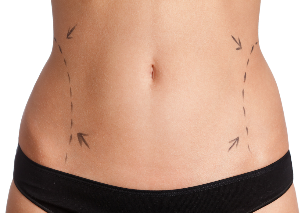 woman’s stomach marked up with dotted lines on each side for body contouring or liposuction procedure