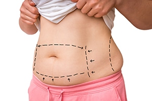 Plastic surgery doctor draw lines with marker on patient belly