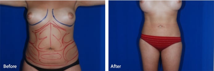 before and after image of mommy makeover Boca Raton