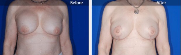 before and after image of Breast Implant Revision Boca Raton
