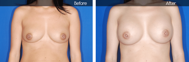 before and after image of breast augmentation Boca Raton