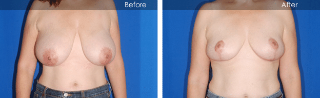 before and after image of Breast Reduction Boca Raton