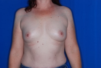Before Image: Breast Augmentation - front