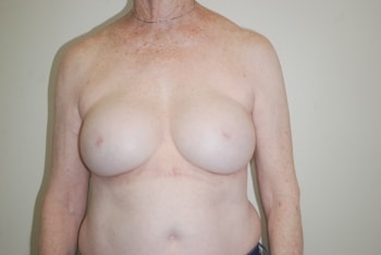 After Image: Breast Implant Revision - front