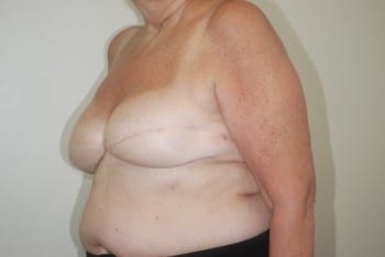 After Image: Breast Implant Revision - left-front-oblique
