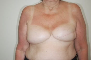 After Image: Breast Implant Revision - front