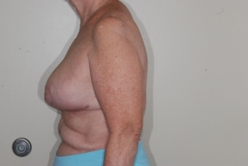 After Image: Breast Implant Revision - left-side