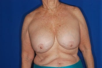Before Image: Breast Implant Revision - front