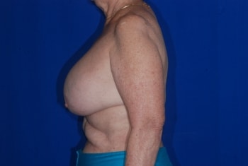 Before Image: Breast Implant Revision - left-side