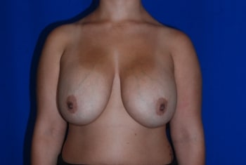 Before Image: Breast Implant Revision - front