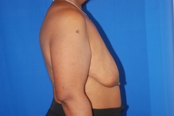 Before Image: Breast Lift - right-side