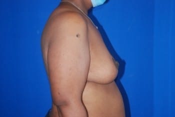 After Image: Breast Lift - right-side