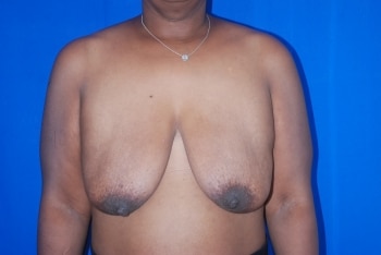 Before Image: Breast Lift - front