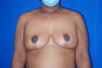 After Image: Breast Lift - front
