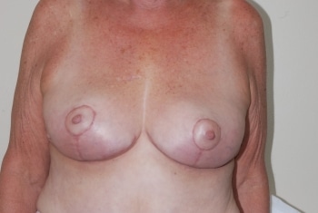 After Image: Breast Lift - front