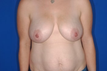 Before Image: Breast Lift1 - front