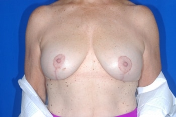 After Image: Breast Lift2 - front