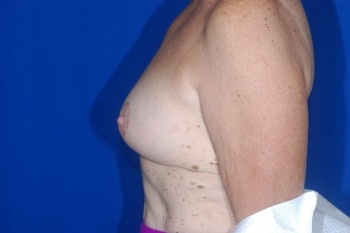 After Image: Breast Lift2 - left-side