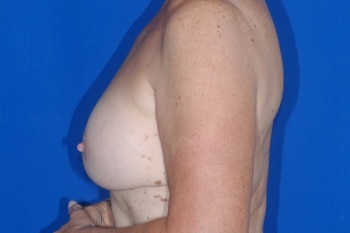 Before Image: Breast Lift2 - left-side