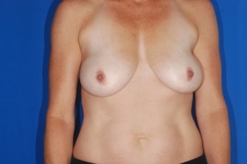 Before Image: Breast Lift6 - front