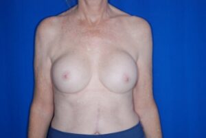 Breast Reaugmentation