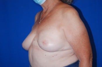 After Image: Breast Reconstruction - left-front-oblique