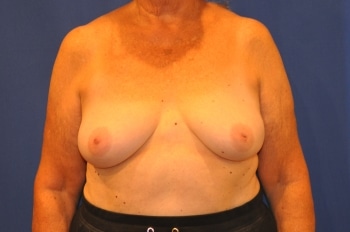 Before Image: Breast Reconstruction - front