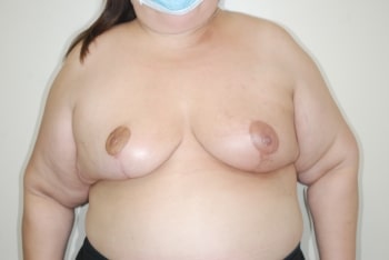 After Image: Breast Reconstruction - front