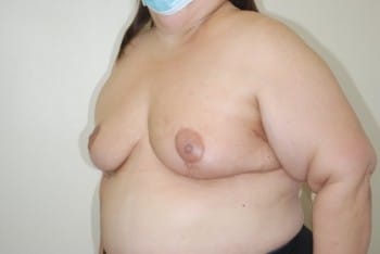 After Image: Breast Reconstruction - left-front-oblique