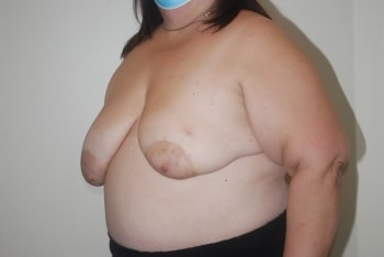Before Image: Breast Reconstruction - left-front-oblique