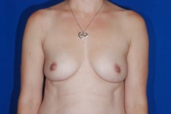 Before Image: Breast Reconstruction - front