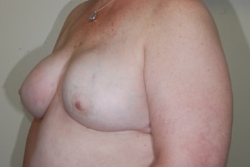 After Image: Breast Reconstruction - left-front-oblique