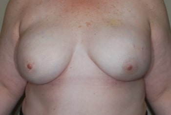 After Image: Breast Reconstruction - front