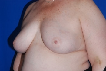 Before Image: Breast Reconstruction - left-front-oblique
