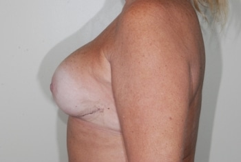 After Image: Breast Reconstruction - left-side
