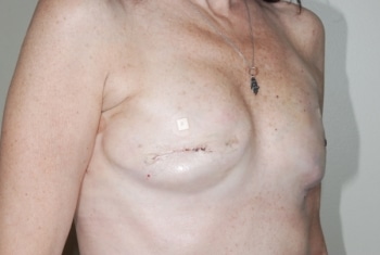 After Image: Breast Reconstruction -