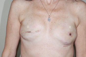 After Image: Breast Reconstruction - front