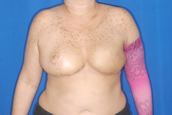 After Image: Breast Reconstruction - front