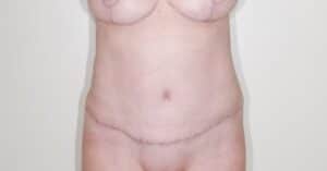 Breast Reduction and Abdominoplasty