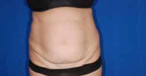 Before Image: Breast Reduction and Abdominoplasty