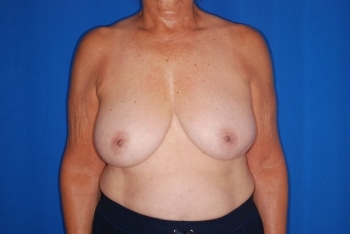 Before Image: Breast Reduction - front
