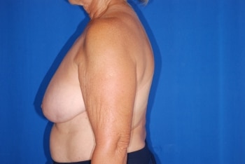 Before Image: Breast Reduction - left-side