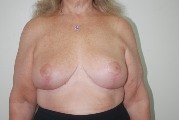 After Image: Breast Reduction - front