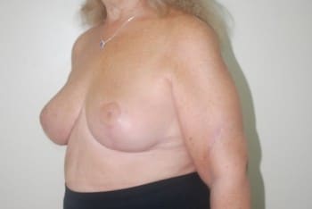 After Image: Breast Reduction - left-front-oblique