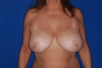 Before Image: Breast Reduction - front