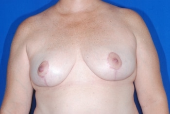 After Image: Breast Reduction - front
