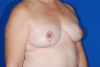 After Image: Breast Reduction - right-front-oblique