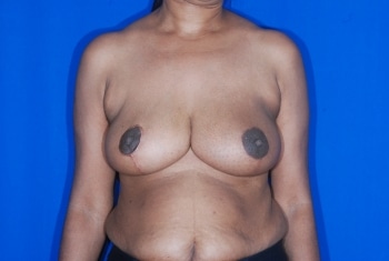 After Image: Breast Reduction2 - front