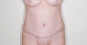 After Image: Full Abdominoplasty