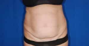 Before Image: Full Abdominoplasty